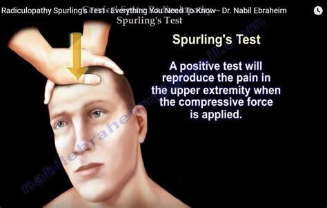 spurling test positive means